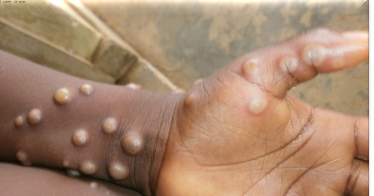 India's first monkeypox case reported in Kerala, Centre rushes high-level team